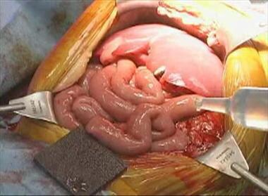 The allograft, prior to closure, positioned within