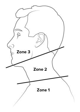 Neck trauma. Zones of the neck. 