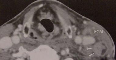 Computed tomography (CT) scan of neck with contras