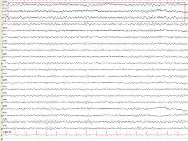 Left temporal intermittent rhythmic delta (TIRDA).