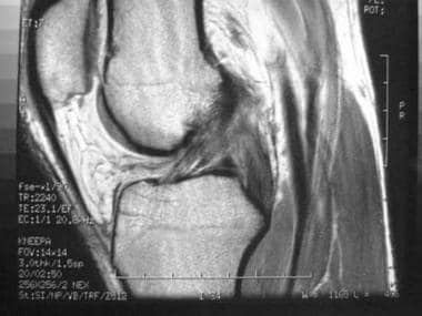 Total knee arthroplasty. Sagittal MRI showing ante