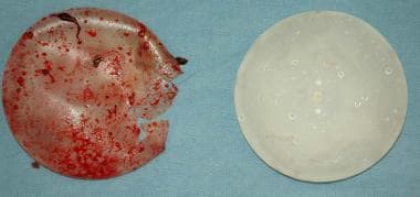 Two breast implants removed at autopsy. The one on