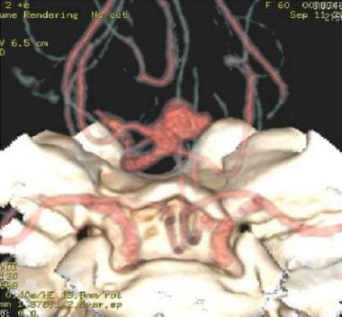 CT angiography shows large basilar tip aneurysm. A