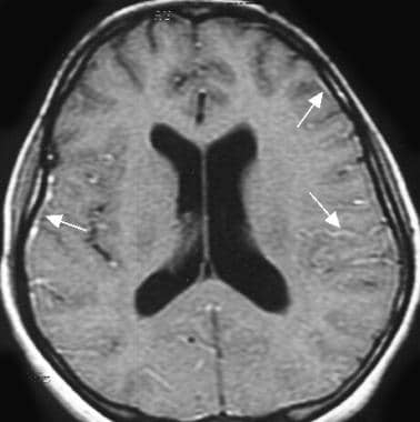 Acute bacterial meningitis. This contrast-enhanced