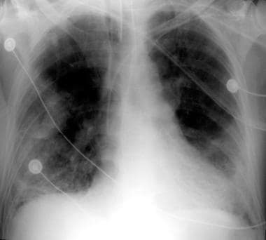 Anteroposterior (AP) portable chest radiograph in 