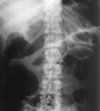 Plain abdominal radiograph in a patient with known