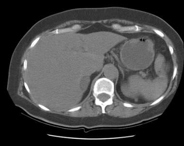 Unenhanced computed tomography scan of adrenal ade
