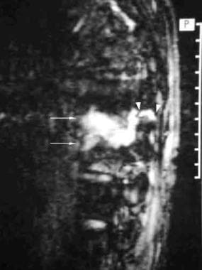 Pseudoarthrosis (same patient as in the previous i