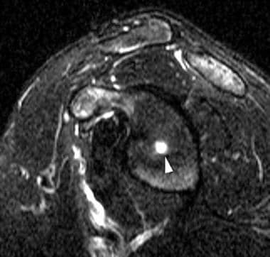 Sagittal T2-weighted image of the right shoulder r