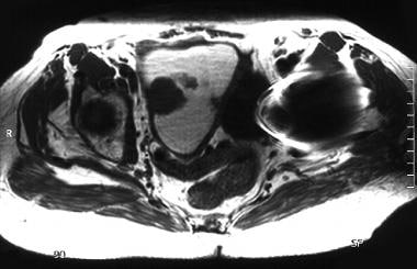 An 83-year-old woman with moderately differentiate
