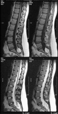 T1- and T2-weighted sagittal MRIs of the lumbar sp