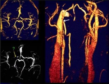 Magnetic resonance (MR) angiograms of the cervical