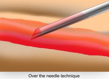 Radial artery cannulation (catheter over needle).