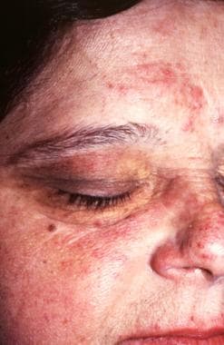 The inflammatory phase of acrodermatitis chronica 