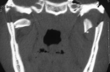 Mandibular fracture. Coronal CT scan demonstrating