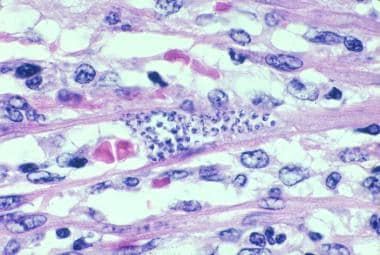 Trypanosoma cruzi in heart muscle of a child who d
