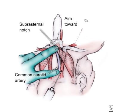 Internal jugular vein, anterior approach. 