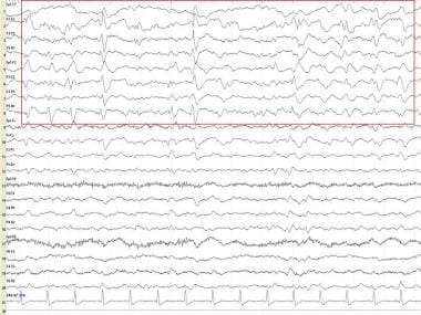 Periodic lateralized epileptiform discharges. 