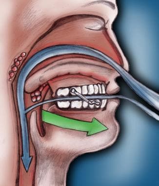 Breathing-related sleep disorder. Lateral, cross-s