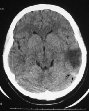 A 32-year-old postpartum patient with headaches. A