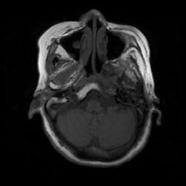 Nonenhanced T1-weighted MRI shows nasopharyngeal c