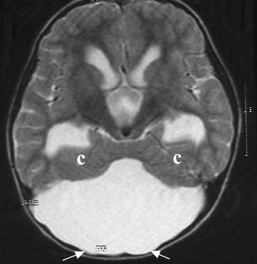 Dandy-Walker malformation. An axial T2-weighted MR