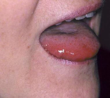 Contact urticaria of the tongue in a patient with 