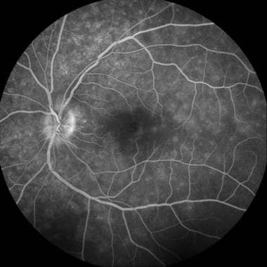 Late-phase fluorescein angiography demonstrating e