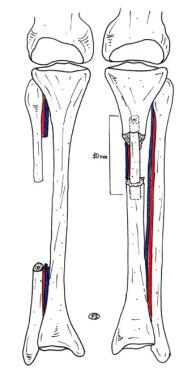 Clinical Case 3. Postoperative drawing. Schematic