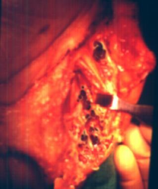 Intraoperative view of the lesion in the first and