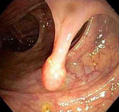 Endoscopic view of a pedunculated polyp. 