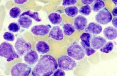 Acute lymphoblastic leukemia (ALL): Bone marrow sh