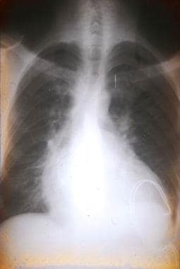 Chest radiograph of a Bolivian patient with chroni