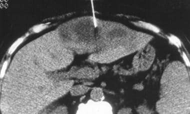 Escherichia coli liver abscess.