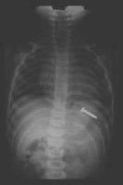 A screw in the stomach; peristaltic action will ca