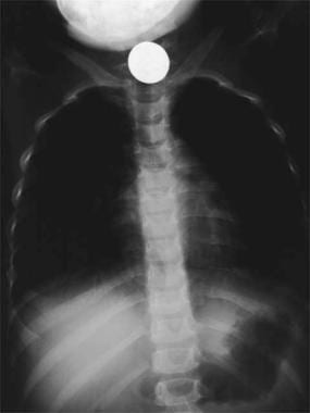 A swallowed coin lodged at the thoracic inlet. Ima
