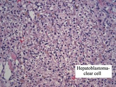 Clear cell hepatoblastoma. Hematoxylin and eosin s
