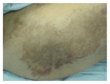 Necrolytic migratory erythema over the back with a