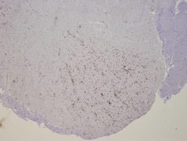 Pathology of motor neuron disorders. Amyotrophic l