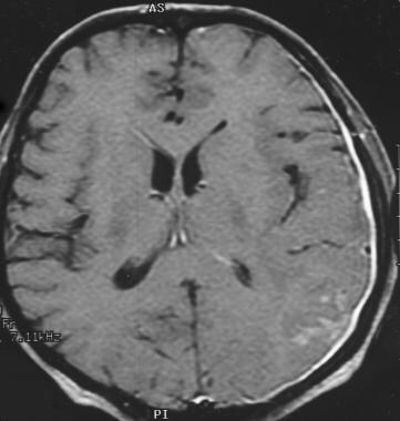 Pachymeningitis and cerebritis in a patient with b