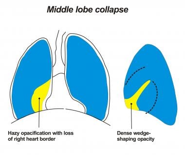 Image depicting a right middle lobe collapsing med