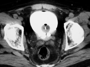 Axial contrast-enhanced CT image through the urete