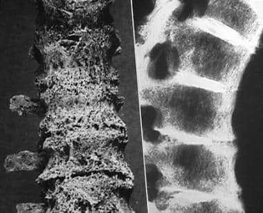 Spine involvement in calcium pyrophosphate deposit