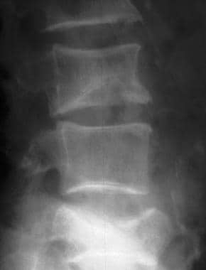 Involutional osteoporosis. Note the lateral wedge 