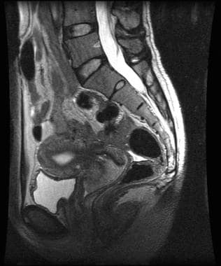 Sagittal T2-weighted magnetic resonance image of s