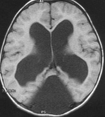 Dandy-Walker malformation. An axial T1-weighted MR