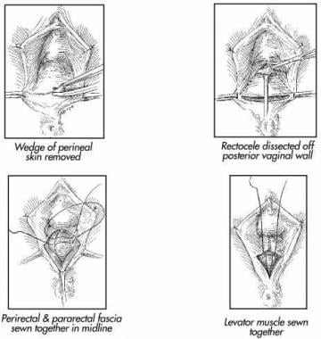 Where do you find rectocele photos?