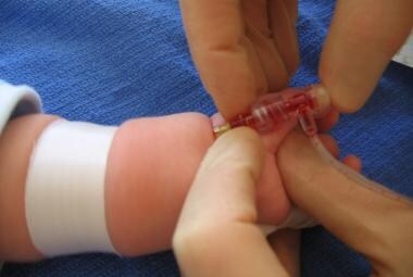 Radial artery cannulation (catheter over needle).