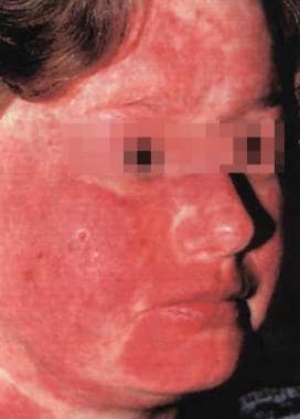 Erythema involving the malar area, forehead, and n