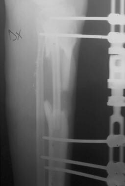 Clinical Case 3. Postoperative radiograph of the o